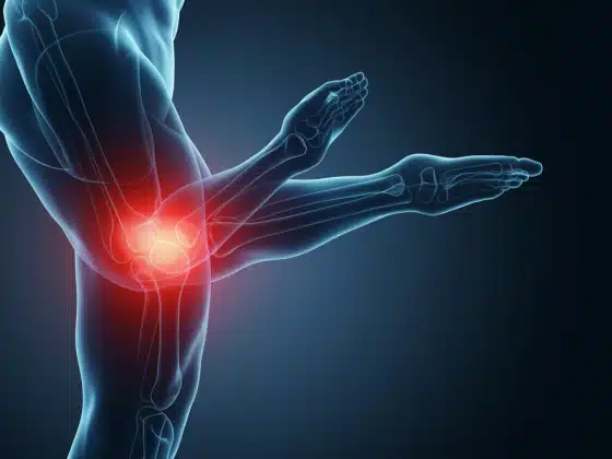 Bong gân là gì? Nguyên nhân, triệu chứng và cách điều trị