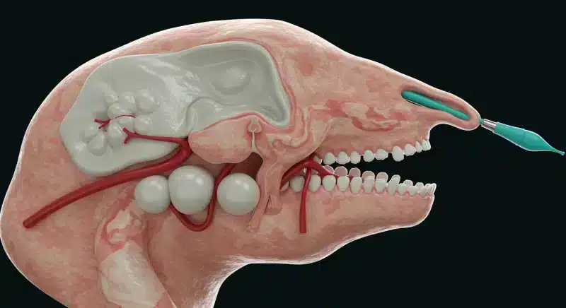 Dị Vật Đường Thở: Hiểu Rõ Nguyên Nhân Và Cách Phòng Ngừa Hiệu Quả