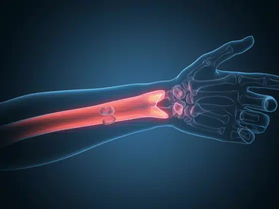Gãy xương là gì? Nguyên nhân, triệu chứng và cách điều trị