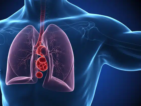 Nhồi Máu Phổi: Nguyên Nhân, Triệu Chứng & Điều Trị Chi Tiết