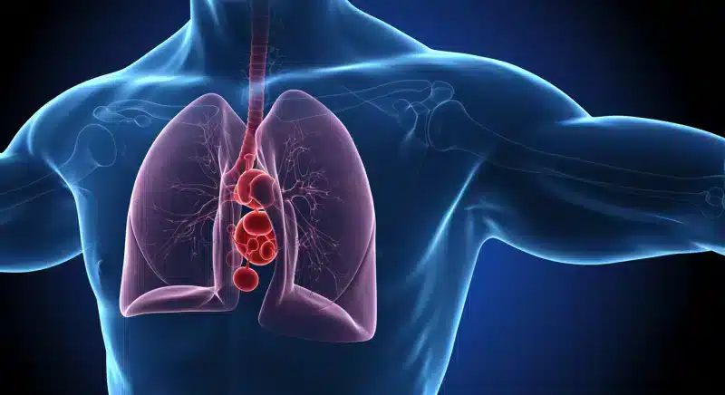 Nhồi Máu Phổi: Nguyên Nhân, Triệu Chứng & Điều Trị Chi Tiết