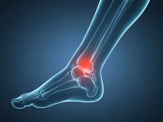 Sưng khớp là gì? Nguyên nhân và cách điều trị sưng khớp