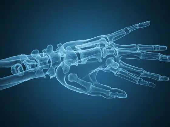 Thoái hóa đa khớp là gì? Dấu hiệu nhận biết, điều trị và cách phòng ngừa thoái hóa đa khớp