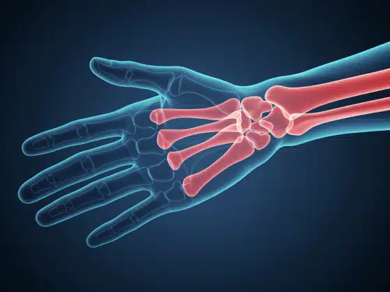 Thoái hoá khớp cổ tay là gì? Nguyên nhân, triệu chứng, phòng ngừa và điều trị bệnh