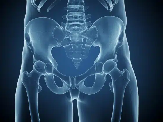 Thoái hóa khớp háng: Triệu chứng, nguyên nhân và điều trị