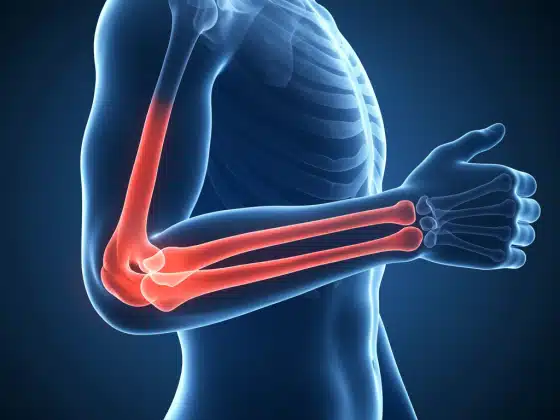Thoái hoá khớp khuỷu tay là gì? Triệu chứng, chẩn đoán và điều trị bệnh