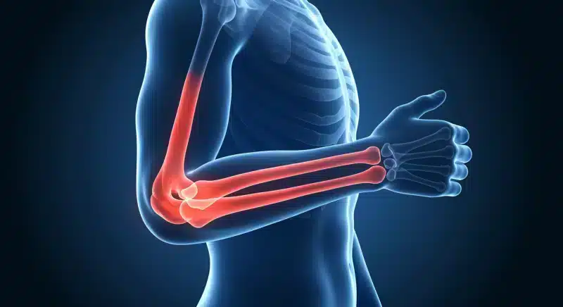 Thoái hoá khớp khuỷu tay là gì? Triệu chứng, chẩn đoán và điều trị bệnh