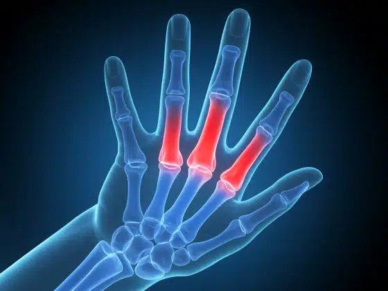Thoái hoá khớp ngón tay: Triệu chứng, nguyên nhân, chẩn đoán và điều trị