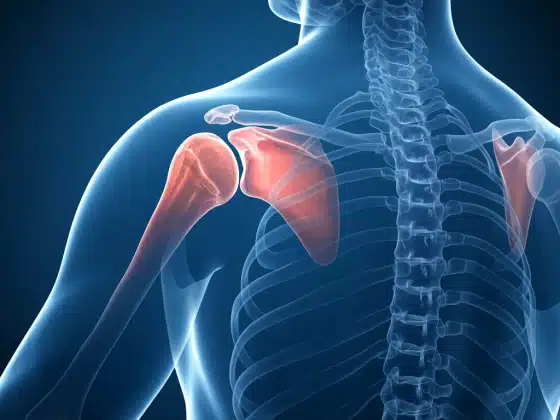 Thoái hóa khớp vai: Triệu chứng, nguyên nhân và cách điều trị