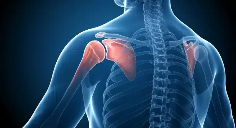 Thoái hóa khớp vai: Triệu chứng, nguyên nhân và cách điều trị