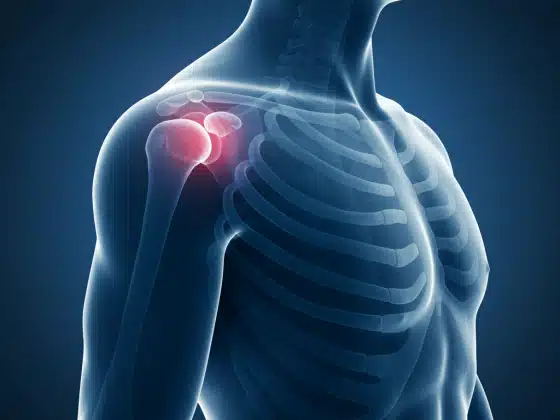 Trật khớp vai: Triệu chứng, nguyên nhân và cách điều trị