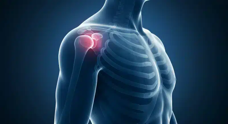 Trật khớp vai: Triệu chứng, nguyên nhân và cách điều trị