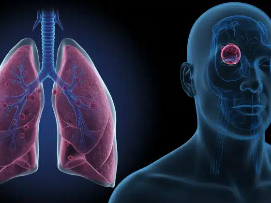 U Phổi: Hiểu Rõ Nguyên Nhân, Triệu Chứng & Cách Điều Trị