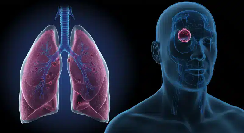 U Phổi: Hiểu Rõ Nguyên Nhân, Triệu Chứng & Cách Điều Trị