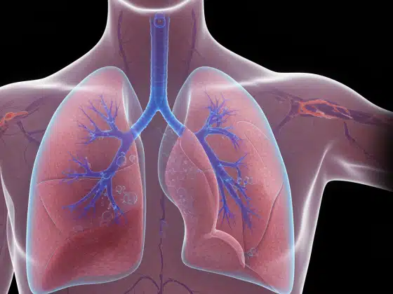 Ung Thư Phổi Giai Đoạn II (Không Tế Bào Nhỏ): Hướng Dẫn Chi Tiết