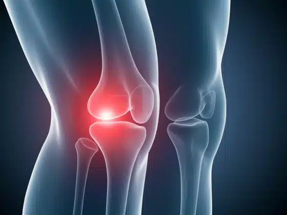 Viêm bao hoạt dịch khớp gối: Triệu chứng, nguyên nhân và điều trị