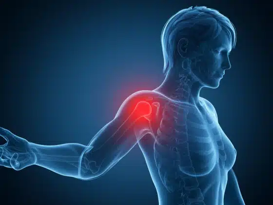 Viêm bao hoạt dịch khớp vai là gì? Nguyên nhân, triệu chứng và cách phòng ngừa