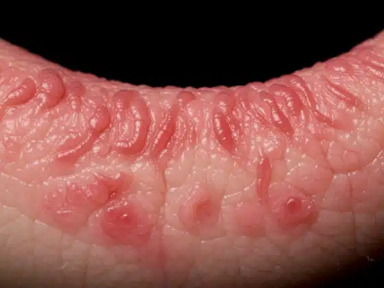 Viêm da dầu: Triệu chứng, nguyên nhân và cách điều trị