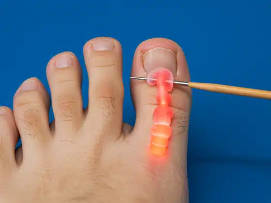 Viêm khớp ngón chân cái: Triệu chứng, nguyên nhân và cách điều trị