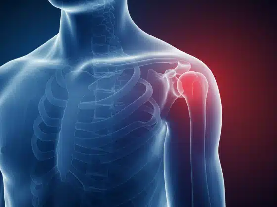 Viêm khớp vai: Triệu chứng, nguyên nhân và cách điều trị