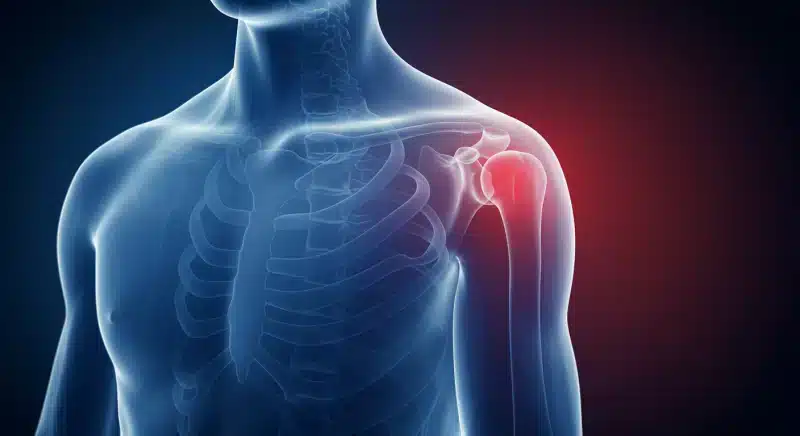 Viêm khớp vai: Triệu chứng, nguyên nhân và cách điều trị