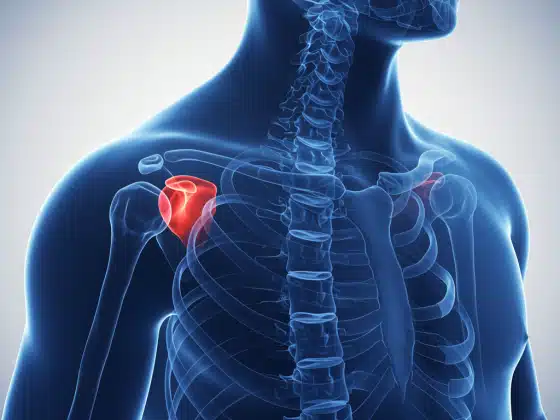 Viêm quanh khớp vai: Triệu chứng, nguyên nhân và cách điều trị