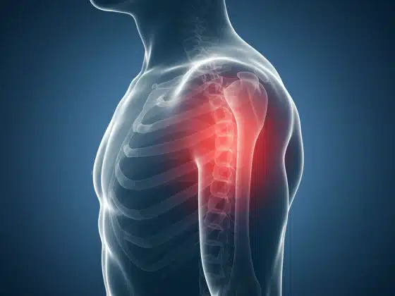 Viêm sụn sườn là gì? Dấu hiệu nhận biết, điều trị và cách phòng ngừa viêm sụn sườn