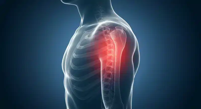 Viêm sụn sườn là gì? Dấu hiệu nhận biết, điều trị và cách phòng ngừa viêm sụn sườn