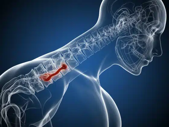 Xẹp đốt sống là gì? Những vấn đề cần biết về xẹp đốt sống