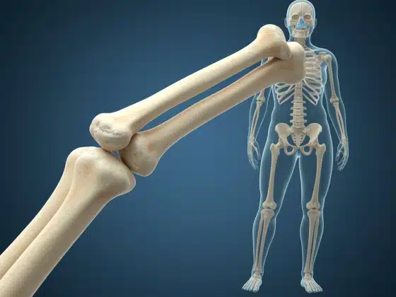 Xương thủy tinh là gì? Nguyên nhân và cách điều trị xương thủy tinh