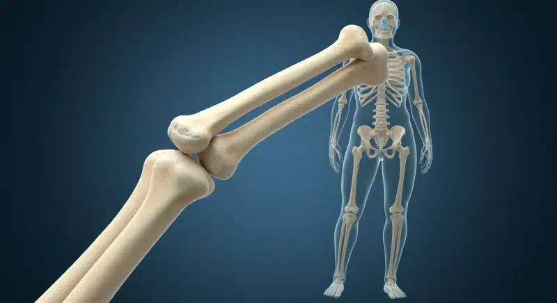 Xương thủy tinh là gì? Nguyên nhân và cách điều trị xương thủy tinh